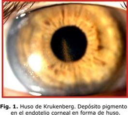glaucoma pigmentario uso de krukemberg