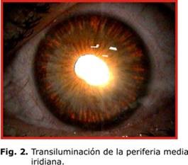 glaucoma pigmentario iris atrofico
