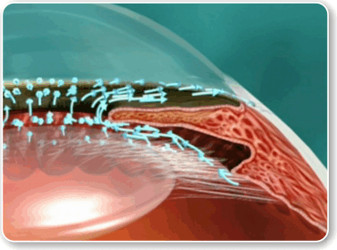 Gonioscopia glaucoma