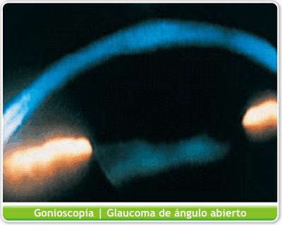 Gonioscopia en glaucoma de ángulo abierto